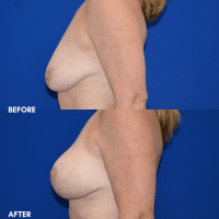 FMPS B&A Template - breast lift