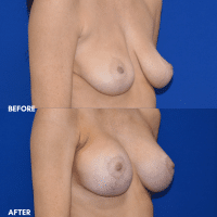 OLD FMPS B&A Template- Sanderson & Braswell Patients - 2025-12-29-breastaugmentation-mastopexy-01 (2)