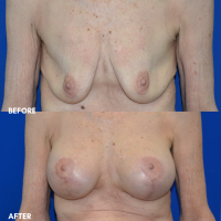 FMPS B&A Template - MASTOPEXY W SILICONE IMPLANTS