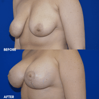 FMPS B&A Template - breast augmentation & mastopexy