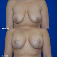FMPS B&A Template - breast augmentation & mastopexy