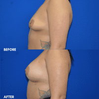 FMPS B&A Template - breast augmentation