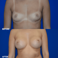 FMPS B&A Template - breast augmentation