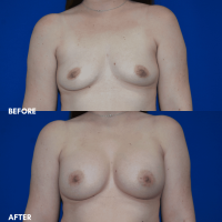FMPS B&A Template - breast augmentation