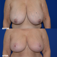 FMPS B & A  - BBR