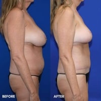 FMPS/CFPS B&A Templates  - TT w/ lipo flanks/Breast reduction Sanderson