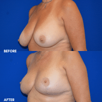 FMPS B & A  - breast reduction 1 angle