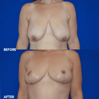 FMPS B & A  - breast reduction