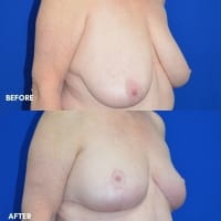 Breast Reduction