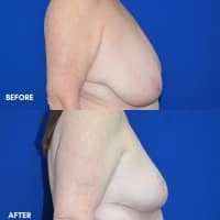Breast Reduction