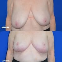 Breast Reduction