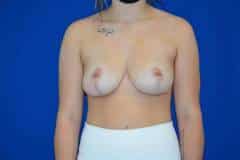 After Breast Reduction Front