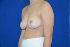 After Breast Reduction Side