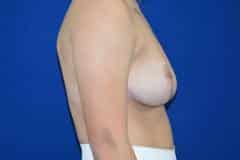 After Breast Reduction Side