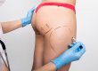 In-Office Liposuction