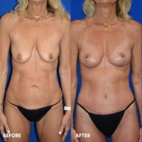 360 Body lift/ Breast lift Braswell
