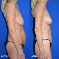 360 body lift/ breast lift Braswell