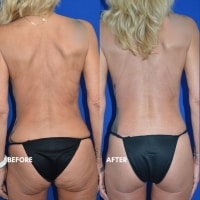 360 body lift/breast lift Braswell