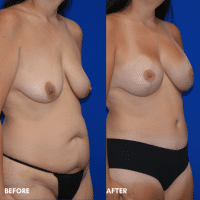 OLD FMPS B&A Template - mommy makeover (2) OLD FMPS B&A Template - mommy makeover (2)