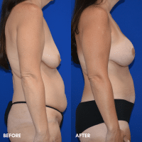 OLD FMPS B&A Template - mommy makeover (3) OLD FMPS B&A Template - mommy makeover (3)