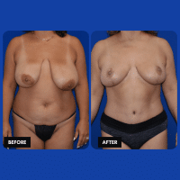 OLD FMPS B&A Template- Sanderson & Braswell Patients - 2026-12-1-mommymakeover-01