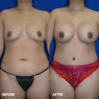 FMPS B&A Template - TT w lipo  of the flanks and lower abdomen BBA