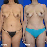 FMPS B&A Template - mommy makeover