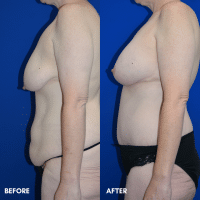 FMPS B&A Template - mommy makeover