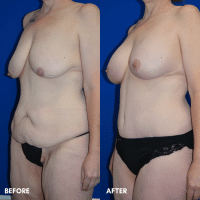 FMPS B&A Template - mommy makeover