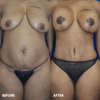 FMPS B&A Template - mommy makeover