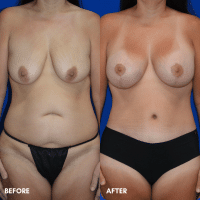 OLD FMPS B&A Template - mommy makeover OLD FMPS B&A Template - mommy makeover