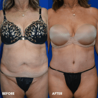 OLD FMPS B&A Template - TT W/ Flank Lipo OLD FMPS B&A Template - TT W/ Flank Lipo