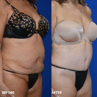 OLD FMPS B&A Template - TT W/ Flank Lipo (3) OLD FMPS B&A Template - TT W/ Flank Lipo (3)