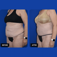 OLD FMPS B&A Template- Sanderson & Braswell Patients - 2025-09-25-tummytuck-liposuctionoftheflanks-02