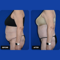 OLD FMPS B&A Template- Sanderson & Braswell Patients - 2025-09-25-tummytuck-liposuctionoftheflanks-03 OLD FMPS B&A Template- Sanderson & Braswell Patients - 2025-09-25-tummytuck-liposuctionoftheflanks-03