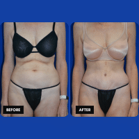 OLD FMPS B&A Template- Sanderson & Braswell Patients - 2025-11-5-tummytuck-liposuctionoftheflanks-01