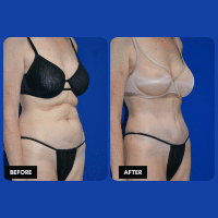 OLD FMPS B&A Template- Sanderson & Braswell Patients - 2025-11-5-tummytuck-liposuctionoftheflanks-01 (2)