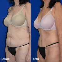 OLD FMPS B&A Template - TT w/ flank lipo (2)