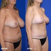 FMPS/CFPS B&A Templates  - TT w/ lipo flanks/Breast reduction Sanderson (2)