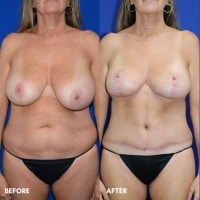 FMPS/CFPS B&A Templates  - TT w/ lipo flanks/Breast reduction Sanderson