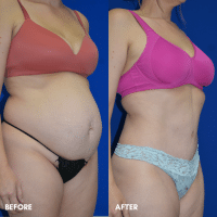 FMPS B&A Template - TT with liposuction of the flanks