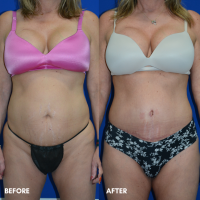 FMPS B&A Template - mini tummy tuck