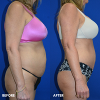 FMPS B&A Template - mini tummy tuck