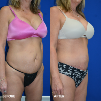 FMPS B&A Template - mini tummy tuck