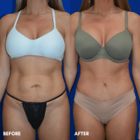 OLD FMPS B&A Template- Sanderson & Braswell Patients - TT- Braswell