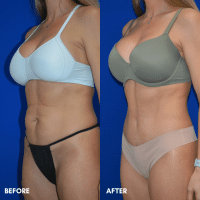 OLD FMPS B&A Template- Sanderson & Braswell Patients - TT- Braswell (2)