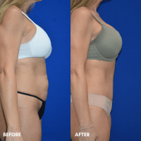 OLD FMPS B&A Template- Sanderson & Braswell Patients - TT-Braswell