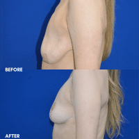 OLD FMPS B&A Template- Sanderson & Braswell Patients - 10-16-25-mastopexy-01 (2) OLD FMPS B&A Template- Sanderson & Braswell Patients - 10-16-25-mastopexy-01 (2)