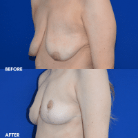 OLD FMPS B&A Template- Sanderson & Braswell Patients - 10-16-25-mastopexy-01 (3) OLD FMPS B&A Template- Sanderson & Braswell Patients - 10-16-25-mastopexy-01 (3)