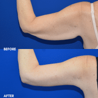 OLD FMPS B&A Template - brachioplasty (2)